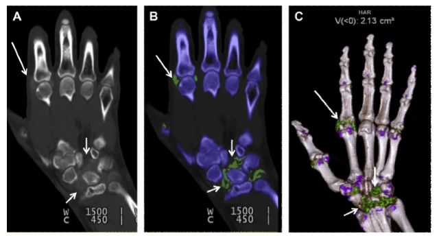 Gout Hand Images Compared