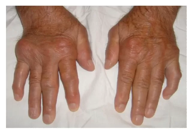 Assessing Gout Damage in Hands