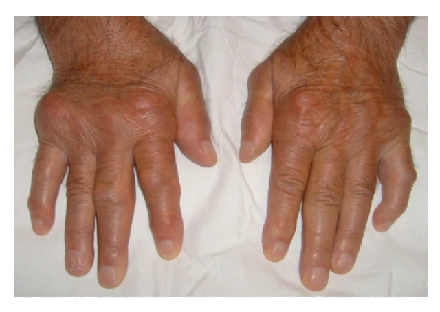 Gouty Tophi impair hand movement